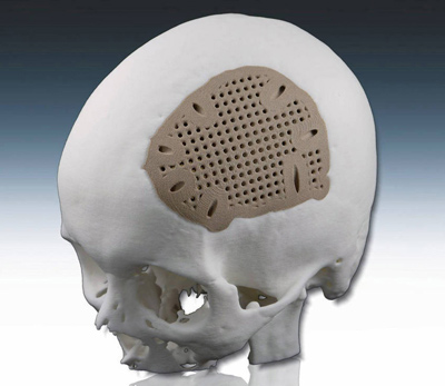 Cranial implant in PEEK manufactured with system EOS