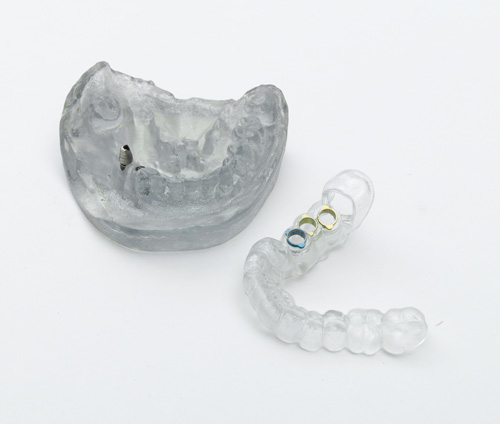 La produccin rpida es algo que se ofrecer pronto a dentistas y pacientes como opcin atractiva y asequible