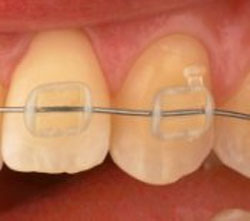 Brackets