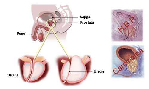 Ware és prostatitis