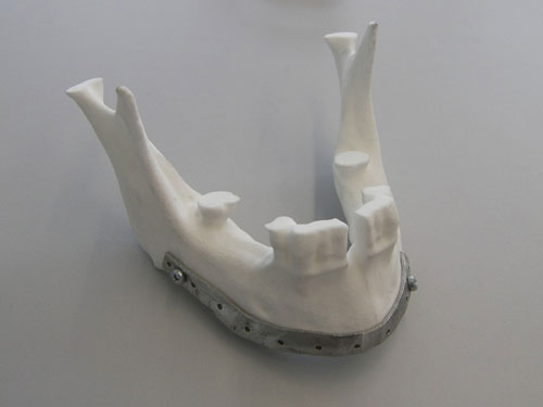 Figura 4: Gua de corte y fijacin para ciruga maxilofacial fabricados por IK4 Lortek
