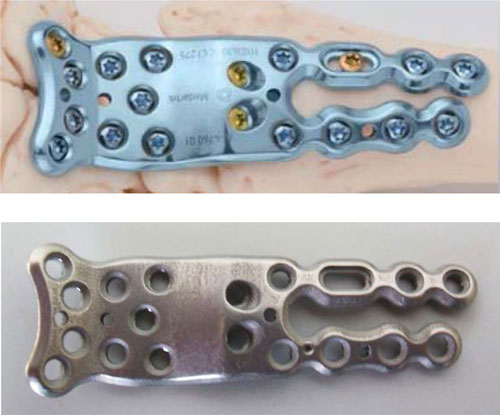 Comparacin de una placa de hueso (arriba) fabricada mediante un proceso convencional (arranque) y otra (abajo) mediante impresin en 3D de metal...