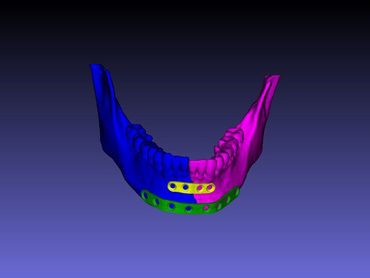 Figura 2. Placas personalizadas de osteosntesis para fractura mandibular, visualizacin en 3D del diseo para la validacin por el mdico...