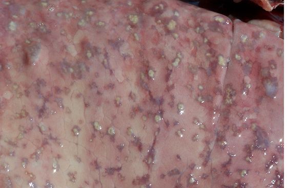 TUBERCULOSIS 1